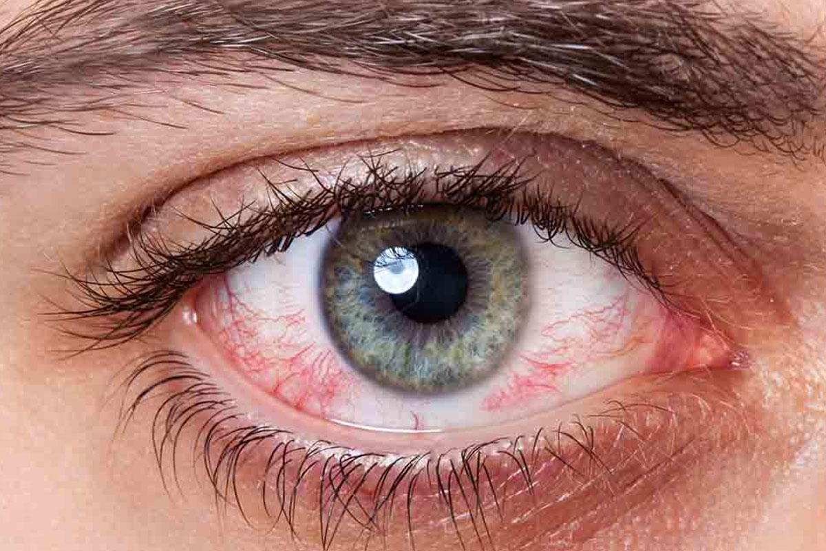 Remedies for red eyes: Natural ways to get rid of problem of red eye - Simplicity